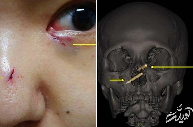 چاپ استیک داخل سر